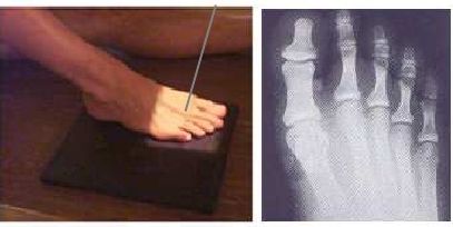 Proyección AP de Dedos del Pie